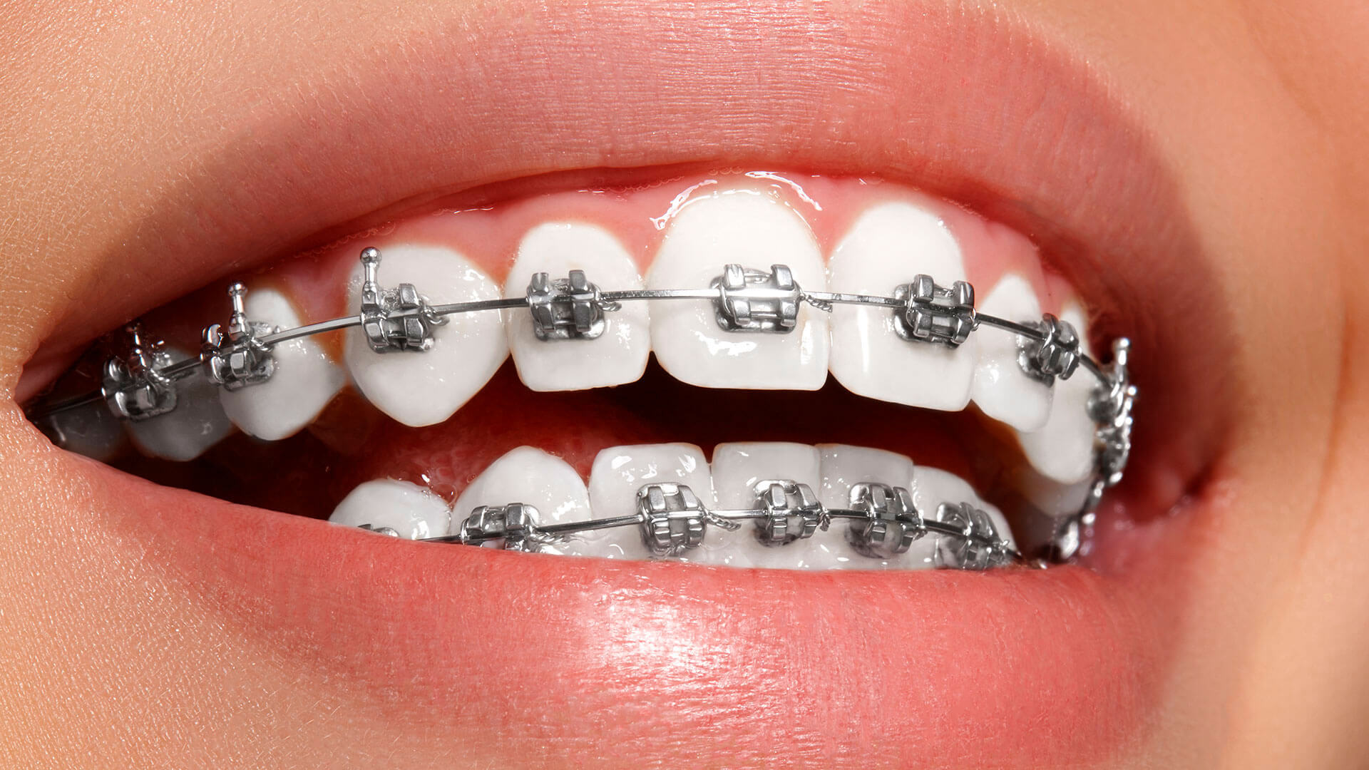 Ortodontia / Orthodontics – Isabel & Dalila Teles