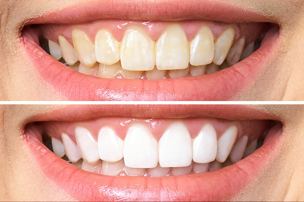 branqueamento-dent-rio-teeth-whitening-isabel-dalila-teles